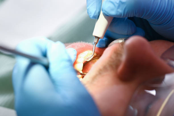 Best Emergency Tooth Extraction in Decatur, GA